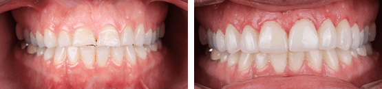 dental veneers in tijuana